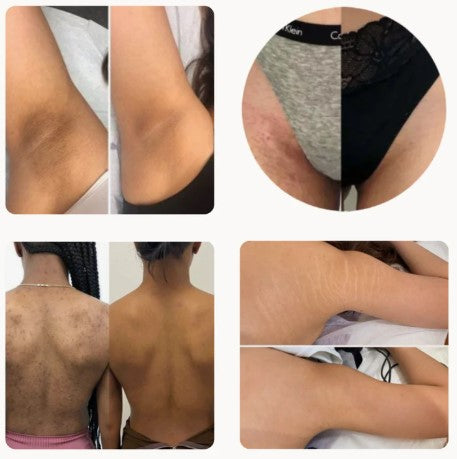 BAIDLEE™ Turmeric and Kojic Acid Pads