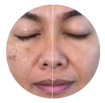 Melasma