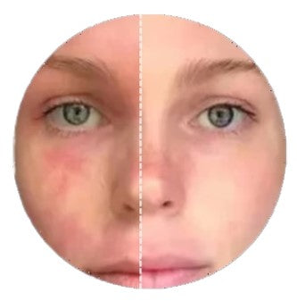 Eczema