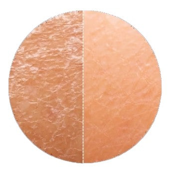 Dry Skin